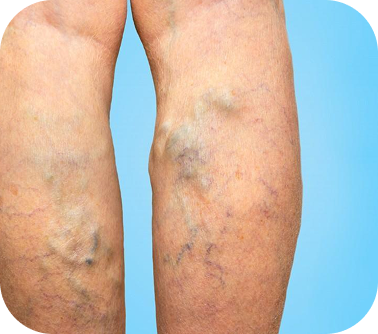 Varicose Veins